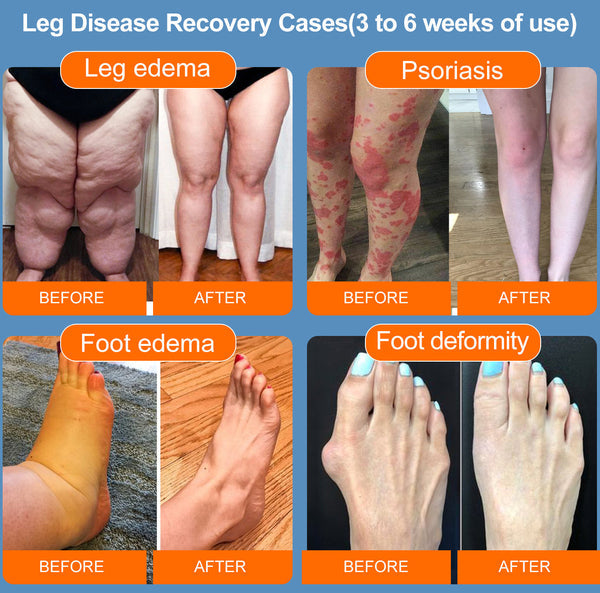 Hermsa® GLP-1 & Super Detox Slimming Diabetic & Wireless EMS Heated Triple Therapy Foot Massager ✅ Supports weight management, heart health, diabetes, gut & women’s health, while firming skin & boosting energy.